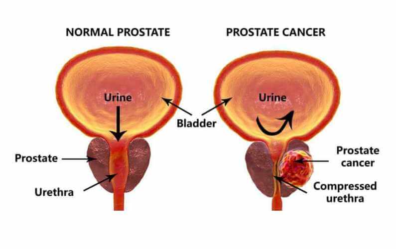 FI-Prostate-Cancer